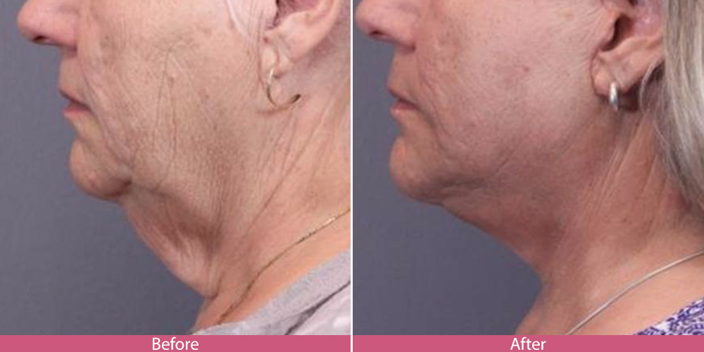 Saggy Neck From Weight Loss WeightLossLook