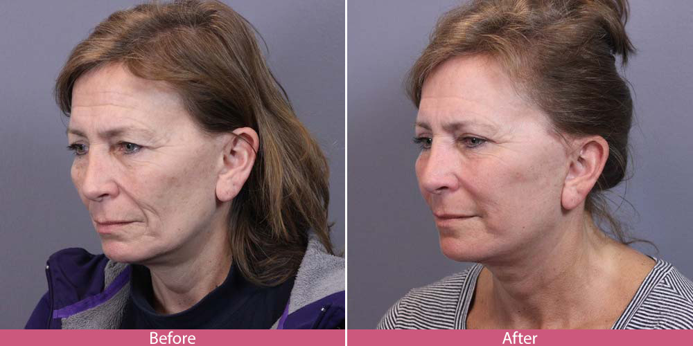 Bellevue facelift - plastic surgeon before-after