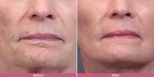 before after laser skin resurfacing