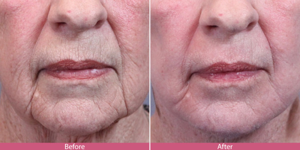 before after laser skin resurfacing