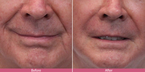 before and after lipo injection