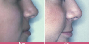 nose surgery before after