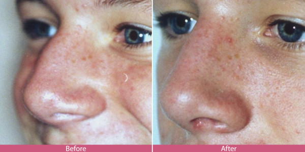 rhinoplasty nose surgery before after
