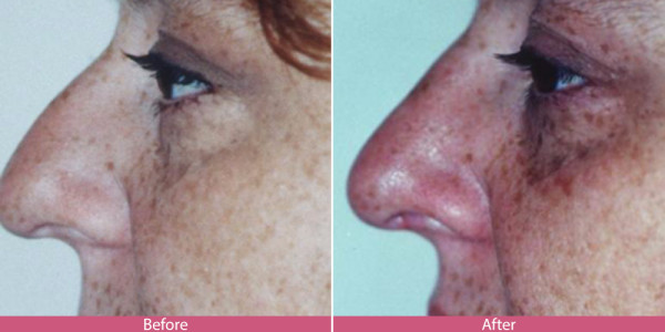 rhinoplasty nose surgery before after
