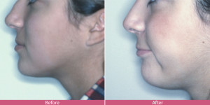 before and after nose surgery rhinoplasty Bellevue