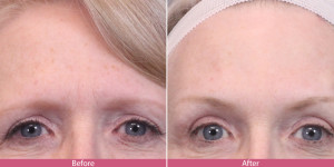 before after brow lift