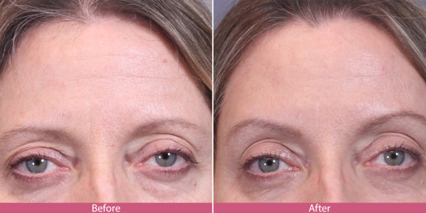 before after brow lift