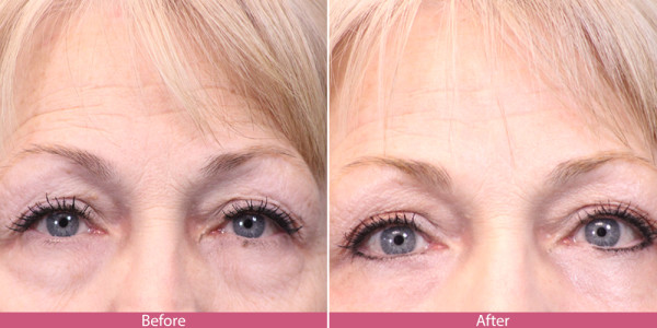 blepharoplasty - eye tuck before after