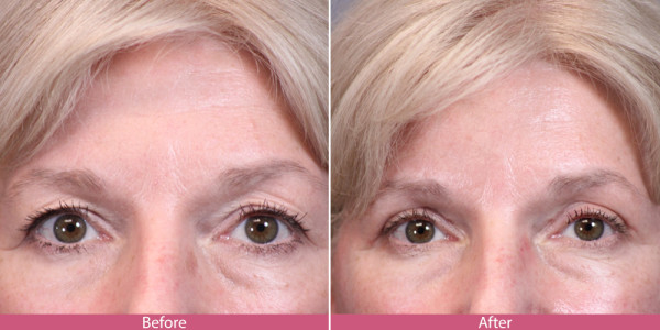 blepharoplasty - eye tuck before aftee