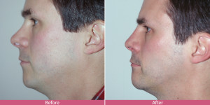 rhinoplasty nose surgery before and after