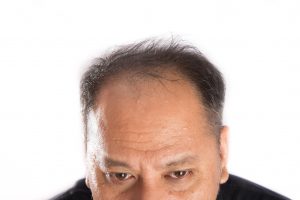Man With Receding Hairline. Brow Lift Dr. Santos