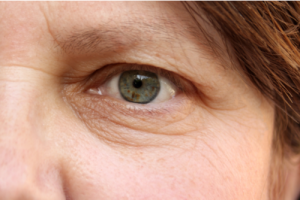 A Photo For a Blog Post About When Is Blepharoplasty Necessary