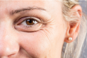 A Photo For A Blog Post About Does Blepharoplasty Make You Look Younger