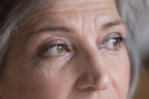 A Photo For A Blog Post About Is A Brow Lift Permanent