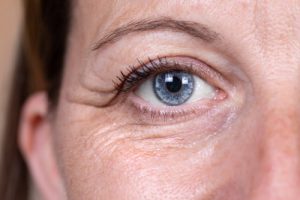 A Photo For A Blog Post About What Is The Fastest Way To Recover From Blepharoplasty